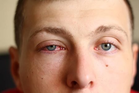 A close-up image of a young male face with a pink eye (conjunctivitis). See more in my portfolio