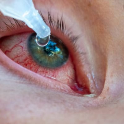 Macro photo of eye allergy after contact lens use Macro photo of eye allergy after contact lens use