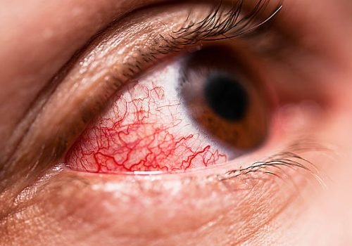 An allergy attack in the eye