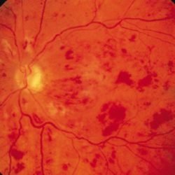 reinal vein occlusion